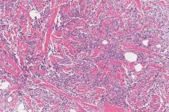 Mammary-type myofibroblastoma