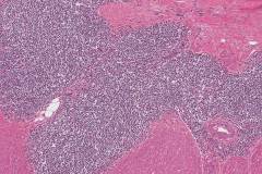 Mantle cell lymphoma involving the colon