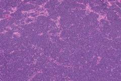 Mantle cell lymphoma