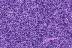 Mantle cell lymphoma