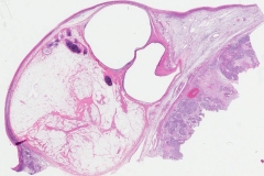 Mature teratoma and yolk sac tumour of the ovary