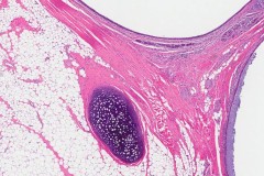 Mature teratoma of the ovary