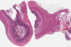 Meckel's diverticulum