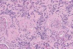 Glomerular sclerosis and ischemic changes with severe interstitial fibrosis and tubular atrophy