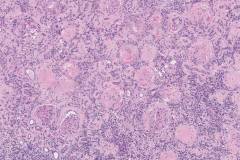 Glomerular sclerosis and ischemic changes with severe interstitial fibrosis and tubular atrophy