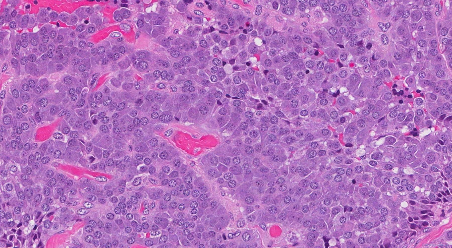 Medullary thyroid carcinoma | Atlas of Pathology