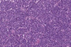 Merkle cell carcinoma