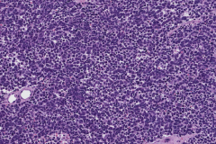 Merkle cell carcinoma