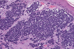 Merkle cell carcinoma