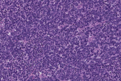 Merkle cell carcinoma