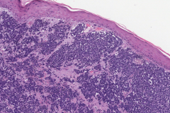 Merkle cell carcinoma