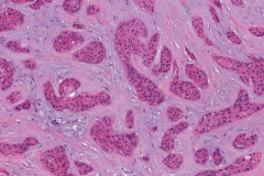 Microcystic adnexal carcinoma