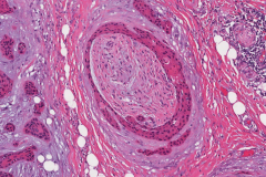 Microcystic adnexal carcinoma