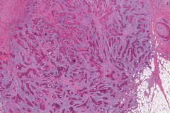 Microcystic adnexal carcinoma