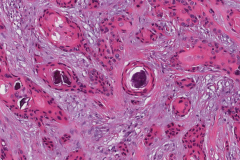 Microcystic adnexal carcinoma