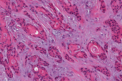 Microcystic adnexal carcinoma