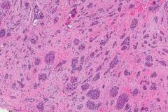 Microcystic adnexal carcinoma