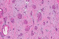 Microcystic adnexal carcinoma