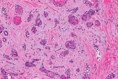 Microcystic adnexal carcinoma