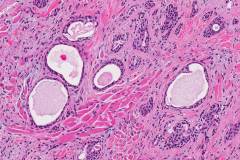 Microcystic adnexal carcinoma