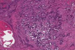 Middle ear neuroendocrine tumour