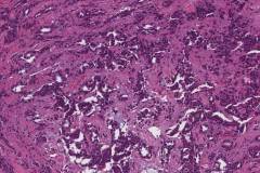 Middle ear neuroendocrine tumour