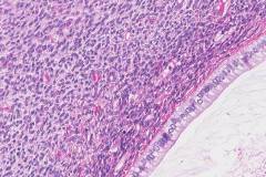 Mixed epithelial and stromal tumour of the kidney