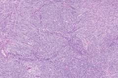 Mixed epithelial and stromal tumour of the kidney