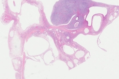 Mixed epithelial and stromal tumour of the kidney