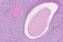 Mixed epithelial and stromal tumour of the kidney