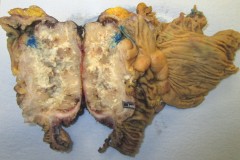 Mucinous adenocarcinoma of the appendix