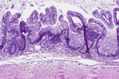 Mucinous borderline tumour of the ovary