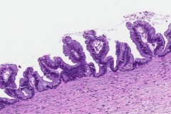 Mucinous borderline tumour of the ovary