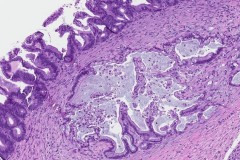 Mucinous carcinoma of the ovary