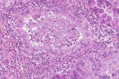 Mucinous carcinoma of the ovary