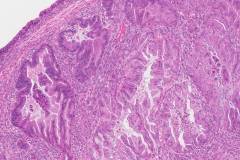 Mucinous carcinoma of the ovary