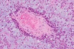 Metastatic mucinous carcinoma of the breast to the brain