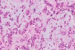 Metastatic mucinous carcinoma of the breast to the brain