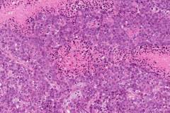 Metastatic mucinous carcinoma of the breast to the brain