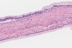 Mucinous cystadenoma of the ovary