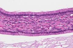 Mucinous cystadenoma of the ovary