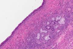 Mucinous cystic neoplasm of the pancreas