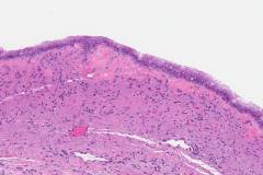 Mucinous cystic neoplasm of the pancreas