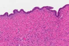 Mucinous cystic neoplasm of the pancreas