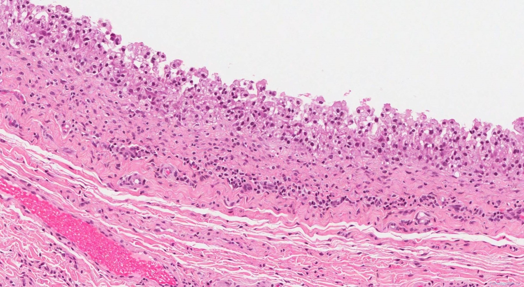 Mucocele Of The Oral Cavity Atlas Of Pathology