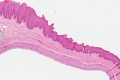 Mucocele of the lip