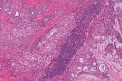 Mucoepidermoid carcinoma