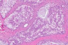 Mucoepidermoid carcinoma