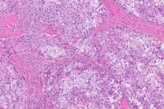 Mucoepidermoid carcinoma