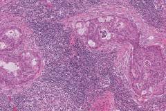 Mucoepidermoid carcinoma